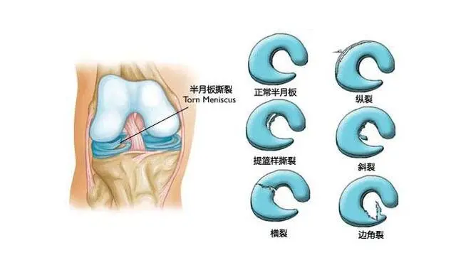 半月板能自愈吗多久能恢复 可以用这3个方式加快康复 哔哩哔哩