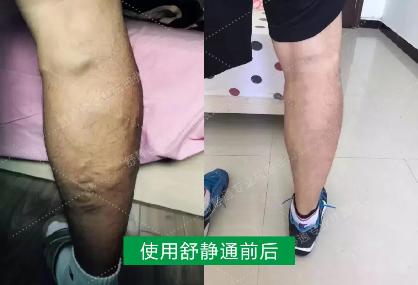 静脉曲张腿肿了怎么办 左侧腿部静脉曲张能治好吗 哔哩哔哩