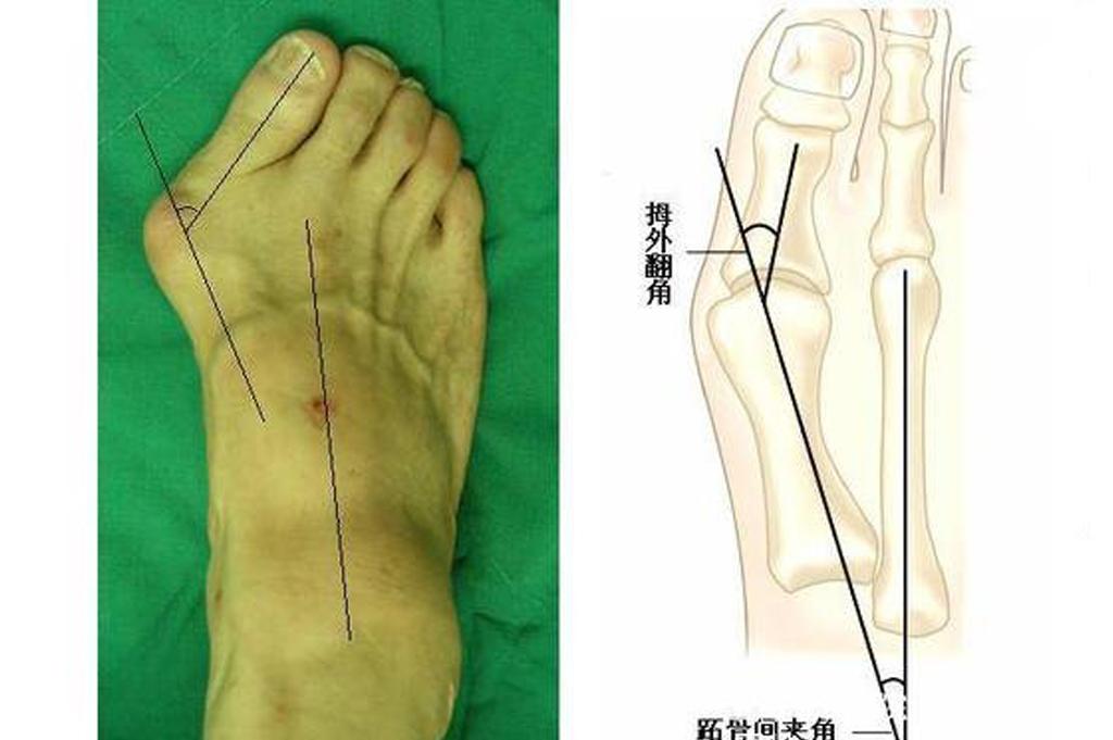 難看,疼痛,穿不了鞋,折磨人的大腳骨外翻該怎樣治療?