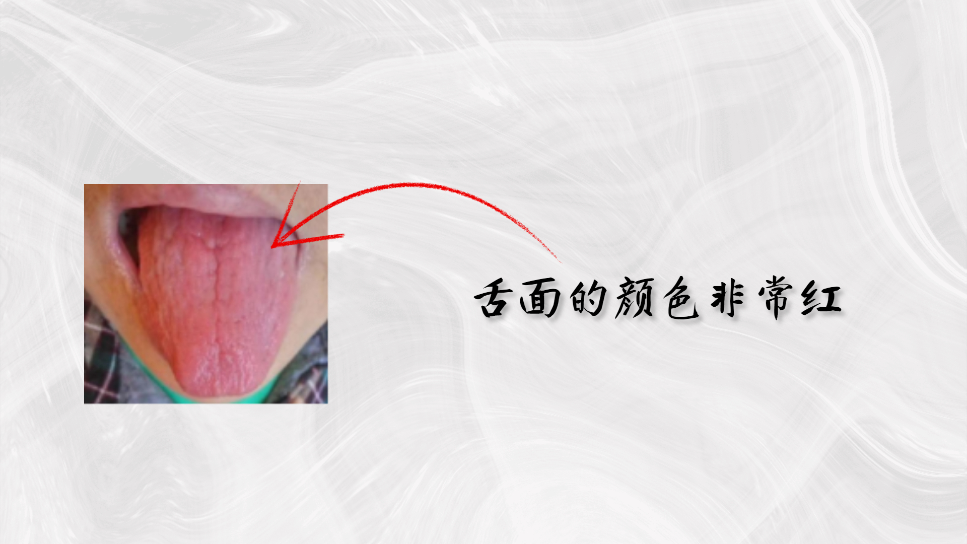 口角炎症状图片_其他皮肤病_北京京城皮肤医院(北京医保定点机构)