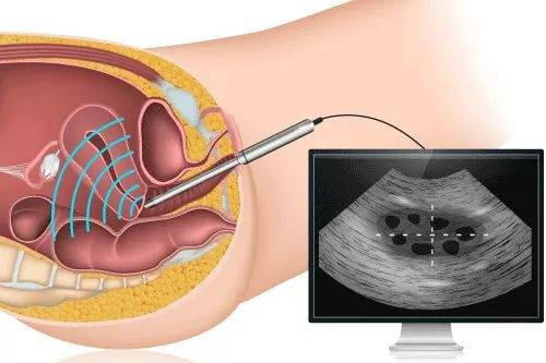 宫腔镜取胚术图片