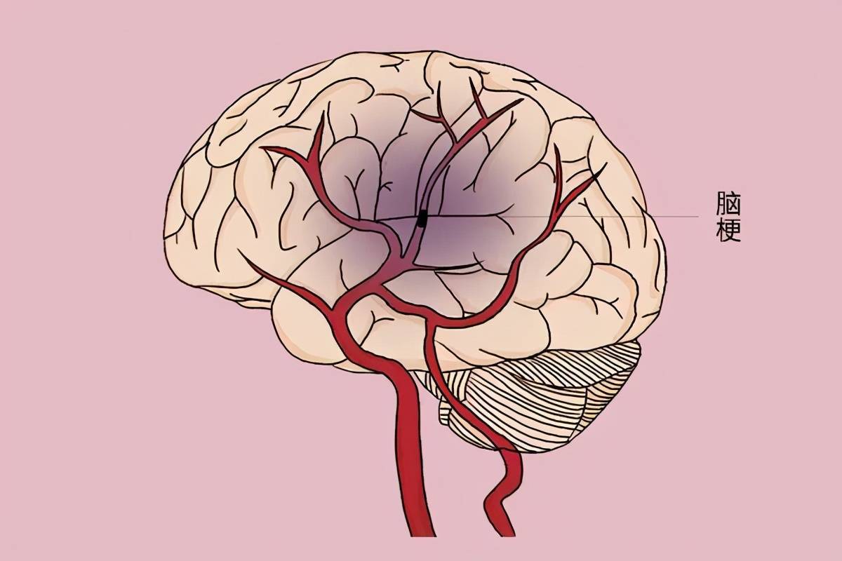 静脉溶栓桥接机械取栓在脑梗死患者中的效果研究