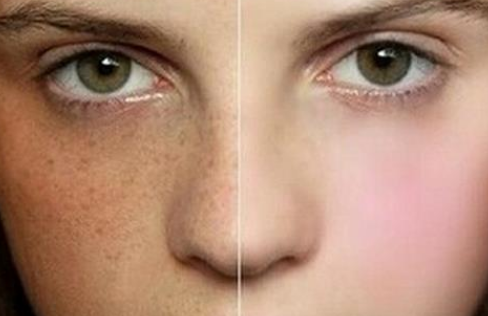 30岁怀孕脸上长斑,生了孩子妊娠斑怎么祛除?饮食防晒不可不少