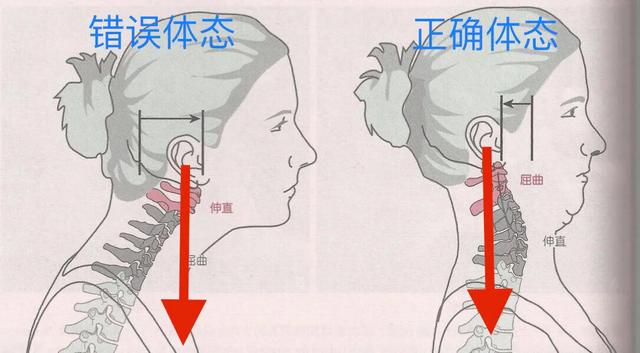 颈椎引起的偏头怎么办