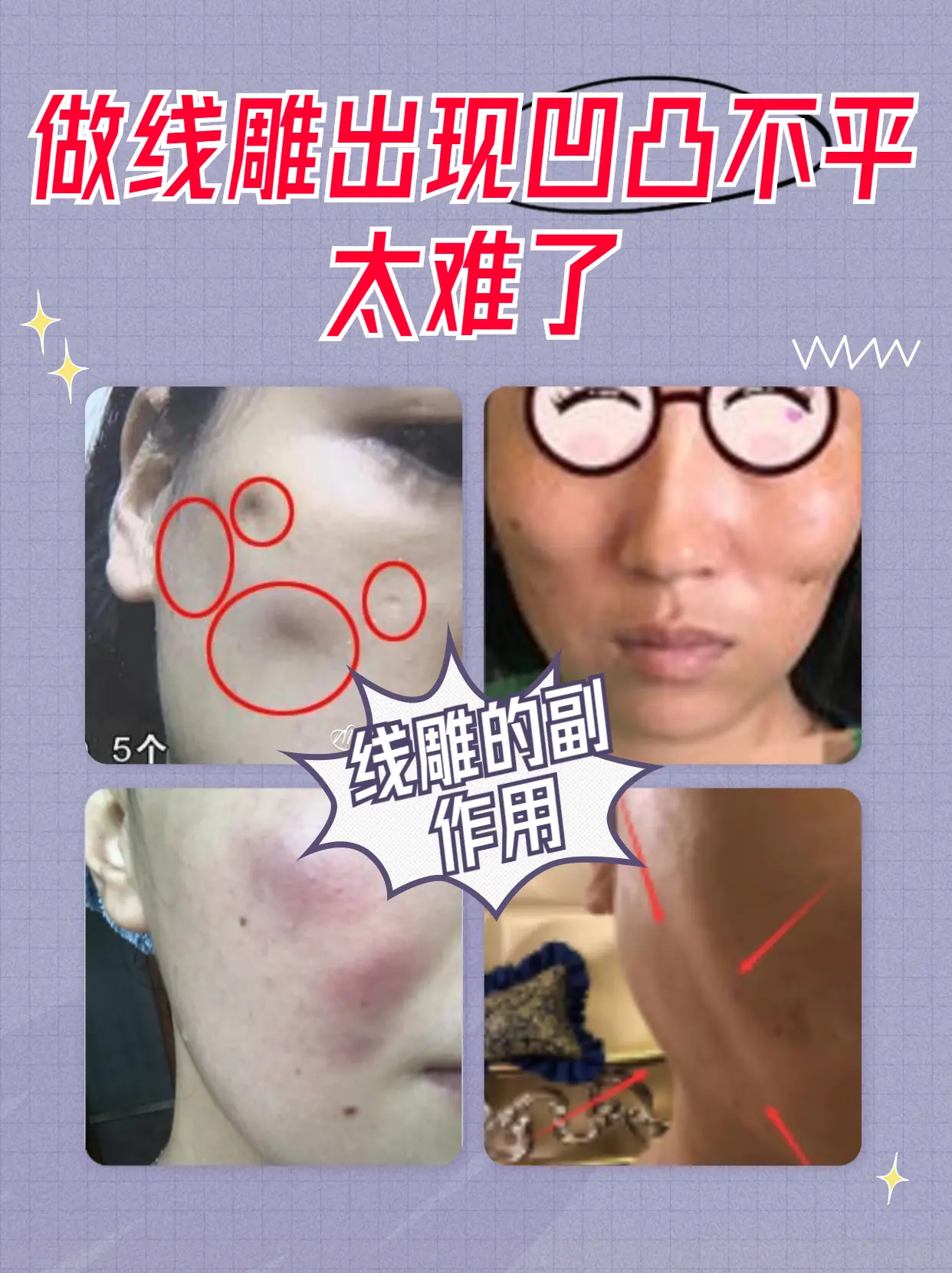 线雕的副作用与危害是什么,做线雕出现凹凸不平太难了 - 哔哩哔哩