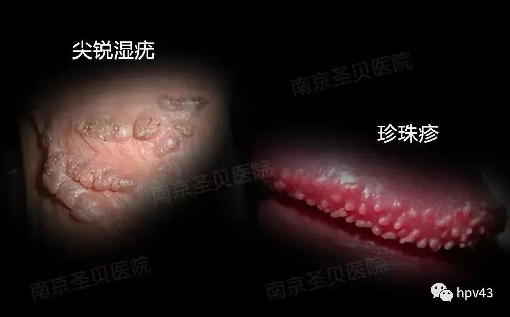 一张图教你辨别尖锐湿疣与珍珠疹