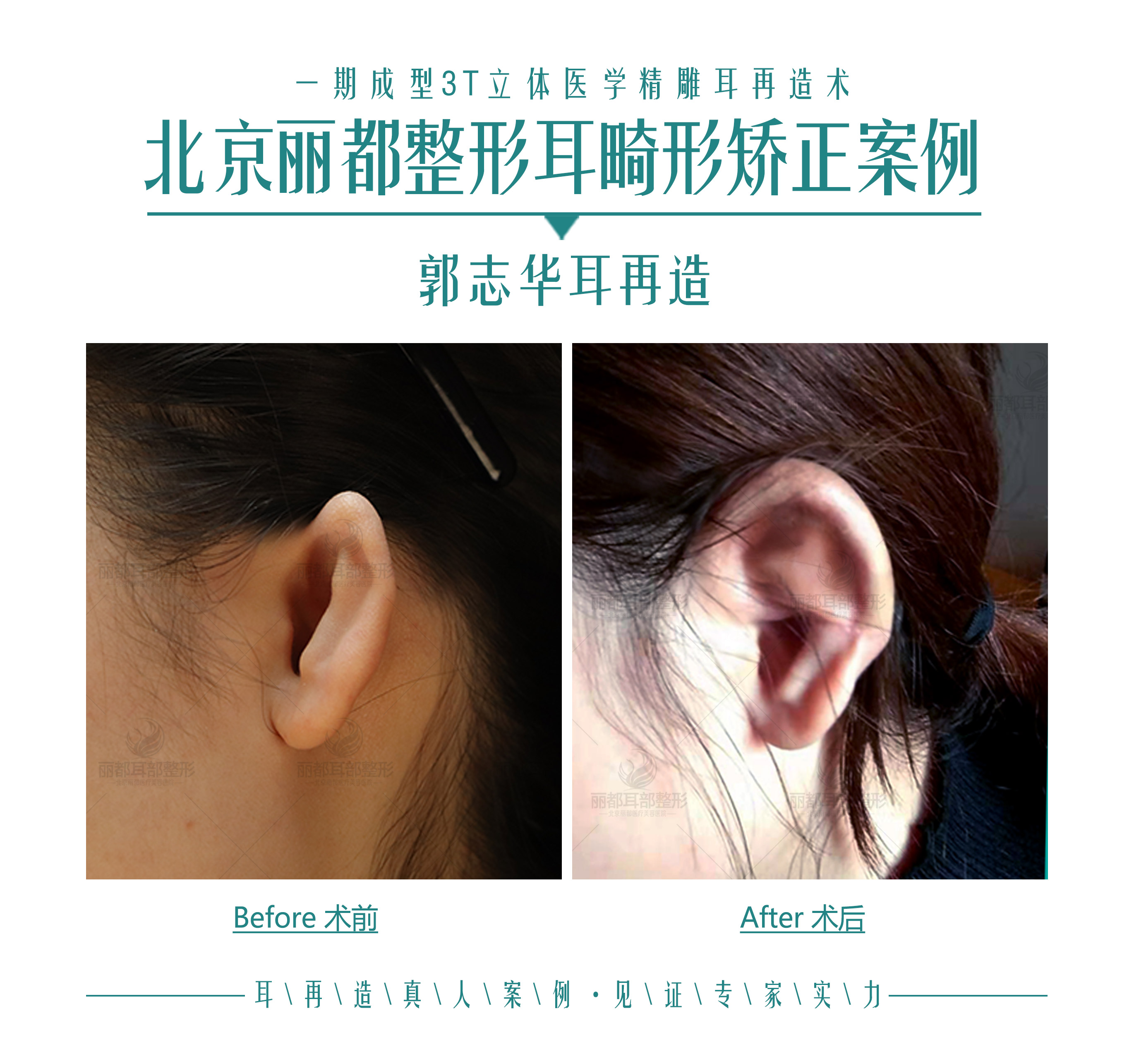 【案例分析】右耳比左耳小，31岁小耳畸形患者忙做手术矫正 - 知乎