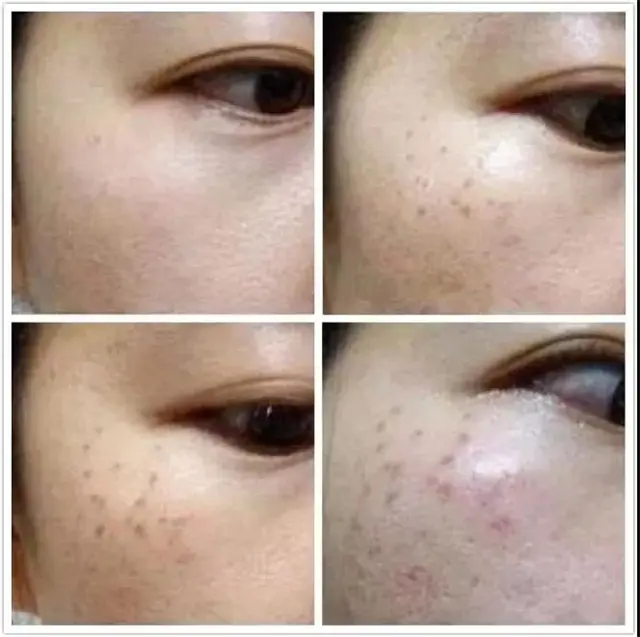 脸上的色斑到底属于什么类型 你知道几种 看图识斑 哔哩哔哩