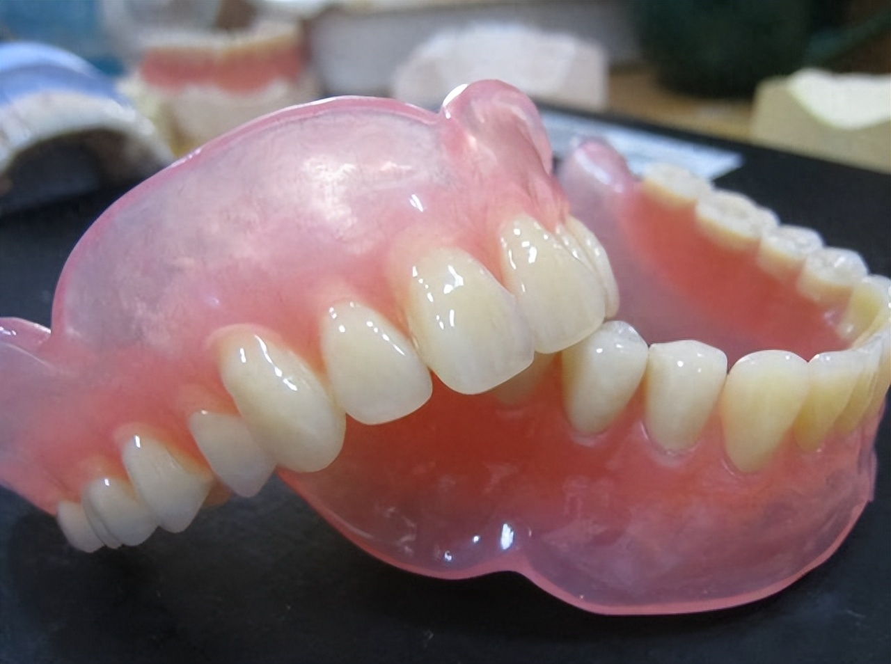 覆蓋式活動假牙Overdenture - 全口重建贋復假牙科 林正忠醫師