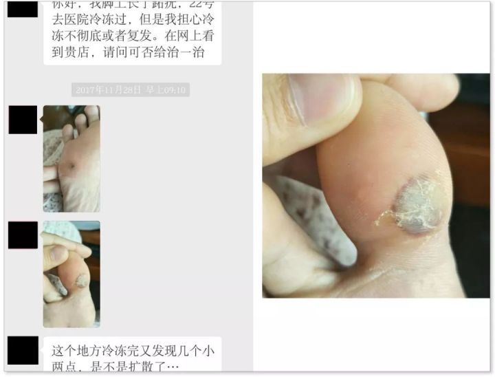 你不得不看的足疣30经典案例