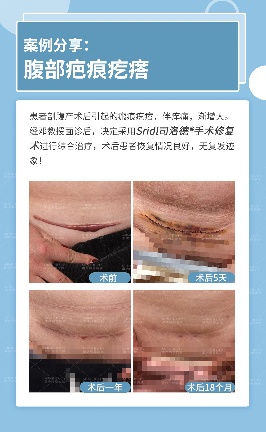 剖腹产后怎么样进行疤痕的处理？ - 知乎