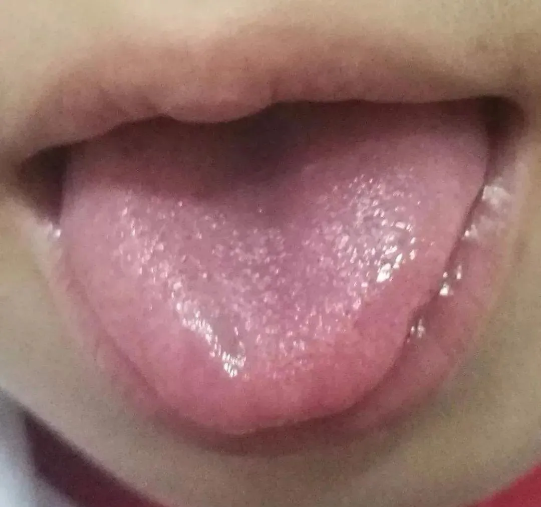 舌头上有裂痕 - 知乎