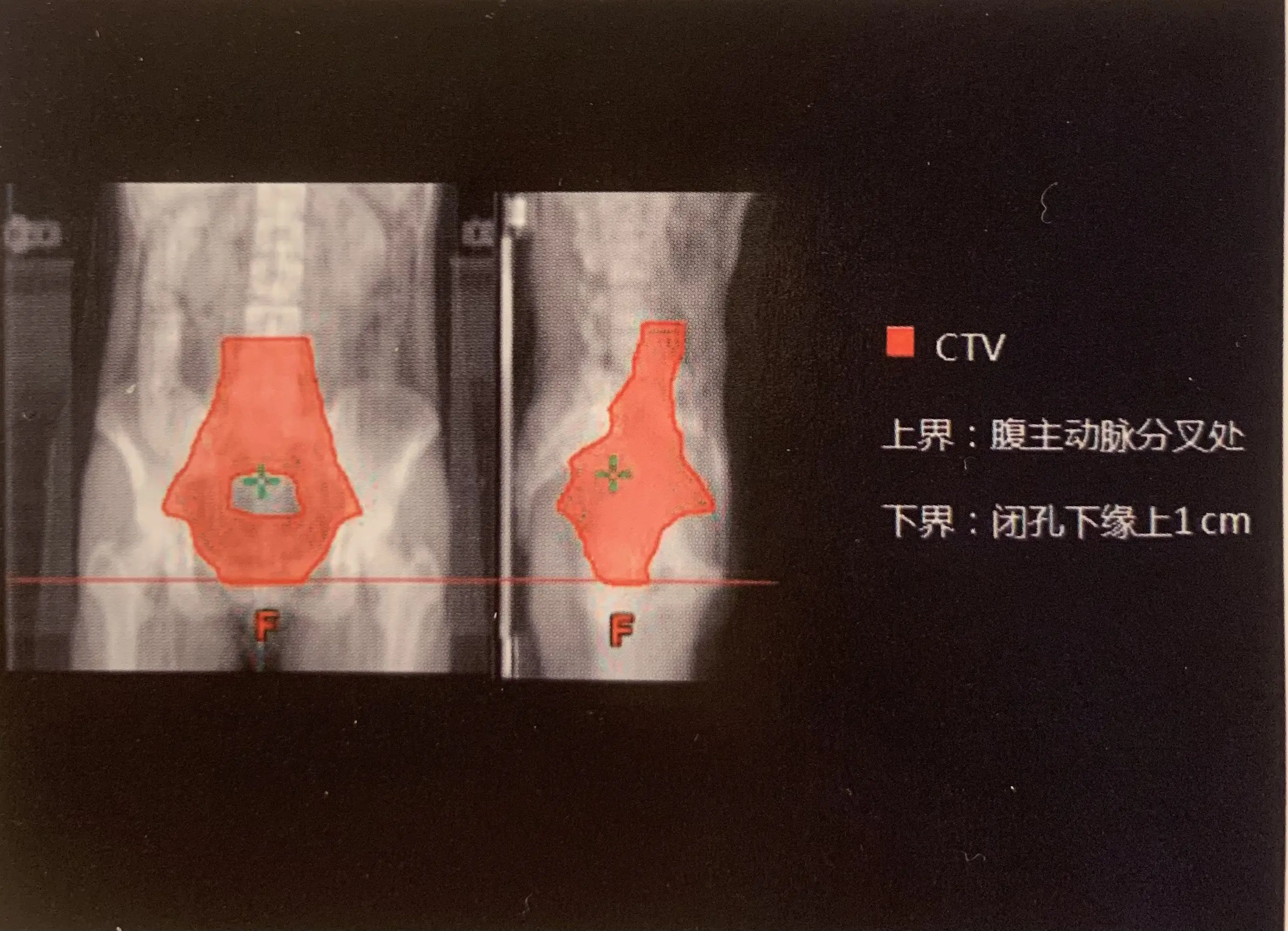 宫颈癌放疗图片大全集图片