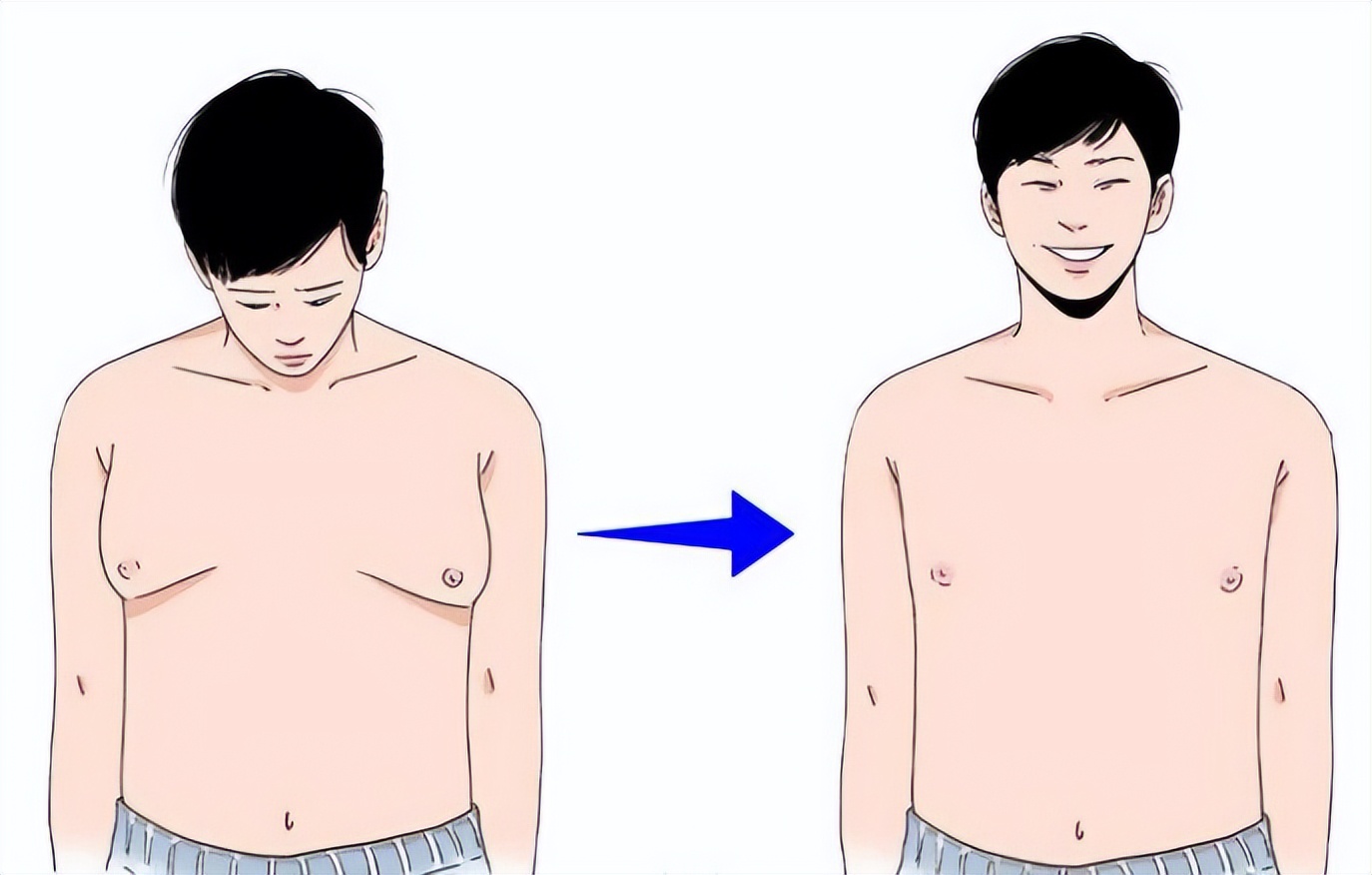 男性乳腺增生手术过程 - 知乎