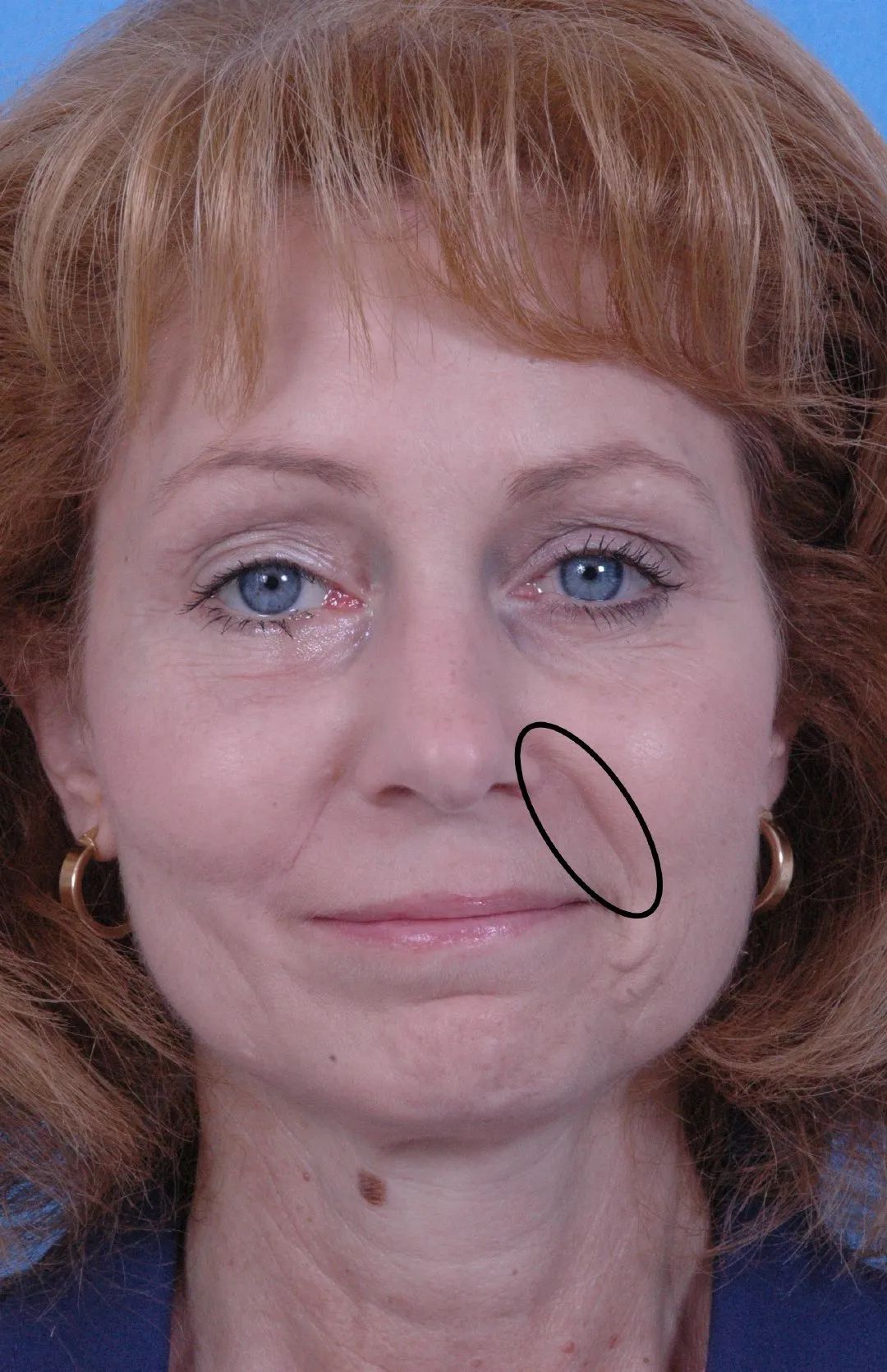 图6-134 唇的外形-口腔颌面及颈部临床解剖学-医学