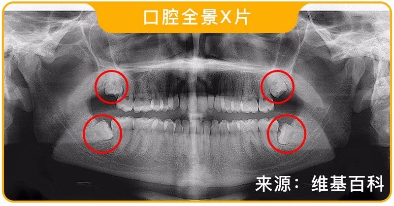 智齿一定要拔掉吗？不疼不拔行不行？ 哔哩哔哩