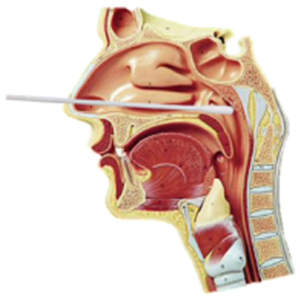 口腔咽拭子采样部位图片