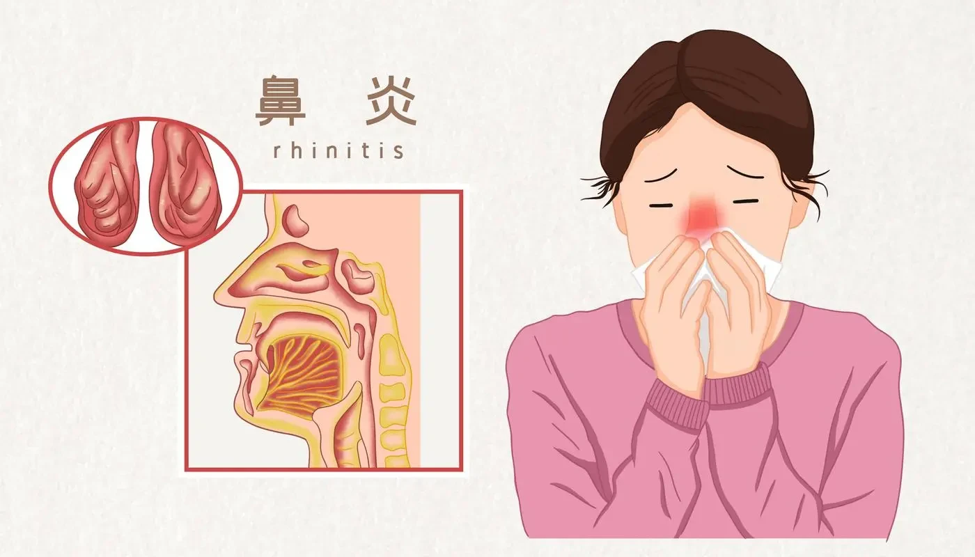 科学了解鼻炎!带你摆脱困扰 - 哔哩哔哩