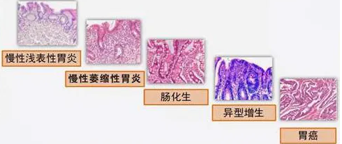 胃炎離癌症有多遠?寧夏康源醫院治腸胃炎怎麼樣啊