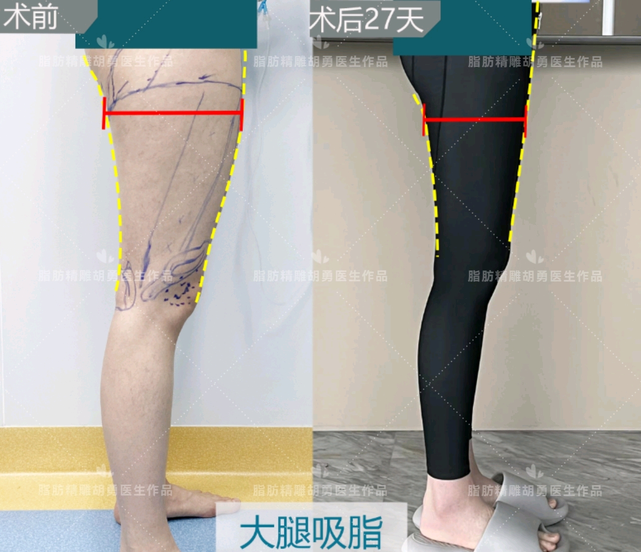 二代威塑-手臂抽脂+大腿抽脂 打造自信迷人曲线 | 佳思优整形医美诊所