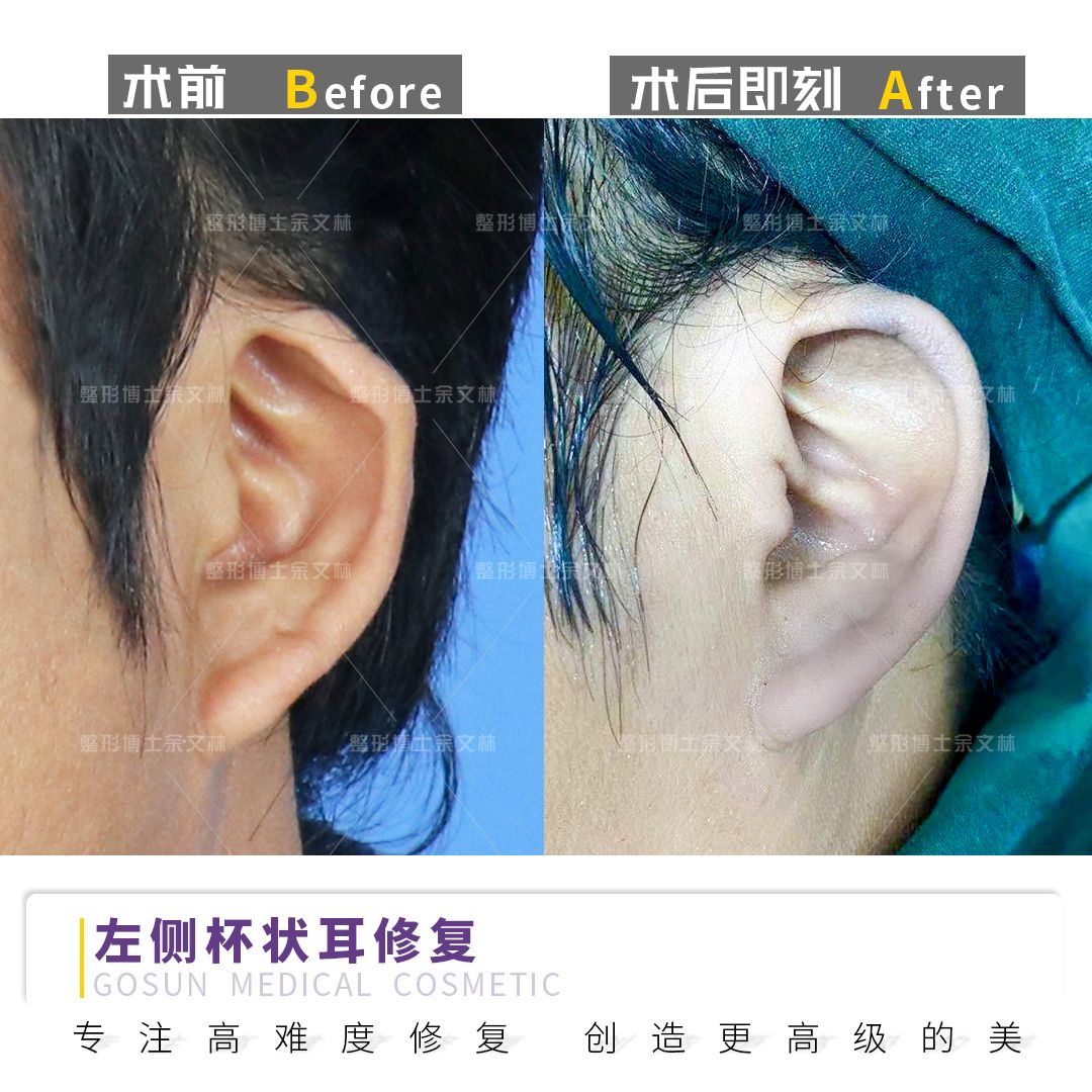 再造耳朵手术：耳再造方法的选择 - 知乎