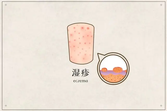 正糖名家糖尿病健康教育：糖友皮肤瘙痒，是患了大病还是虚惊一场- 哔哩哔哩