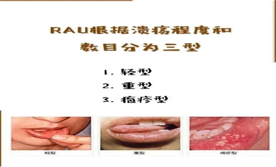 重庆三一八医院主任尚玉山看口腔溃疡好吗？口腔溃疡是什么病？ - 哔哩哔哩