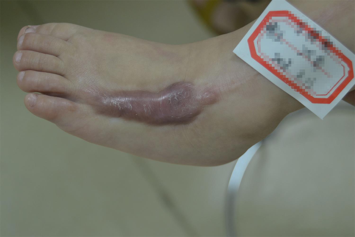 北京丽合医疗美容医院烧伤疤痕用什么药效果好 - 哔哩哔哩
