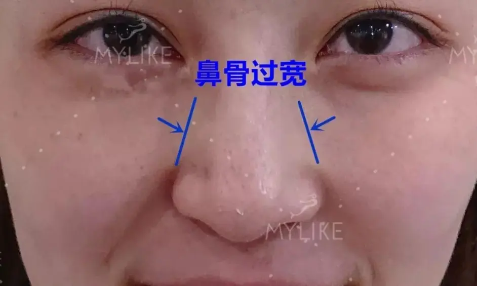 杭州鼻整形张磊 鼻骨过宽该如何改善 哔哩哔哩