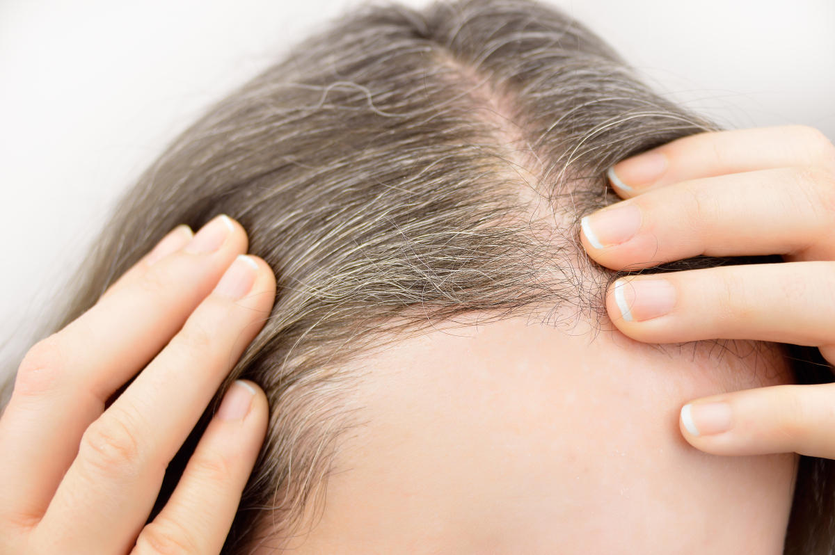 White hair at a young age?White hair grows on the forehead, temples ...
