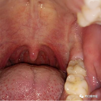 口腔粘膜发生病变怎么办?