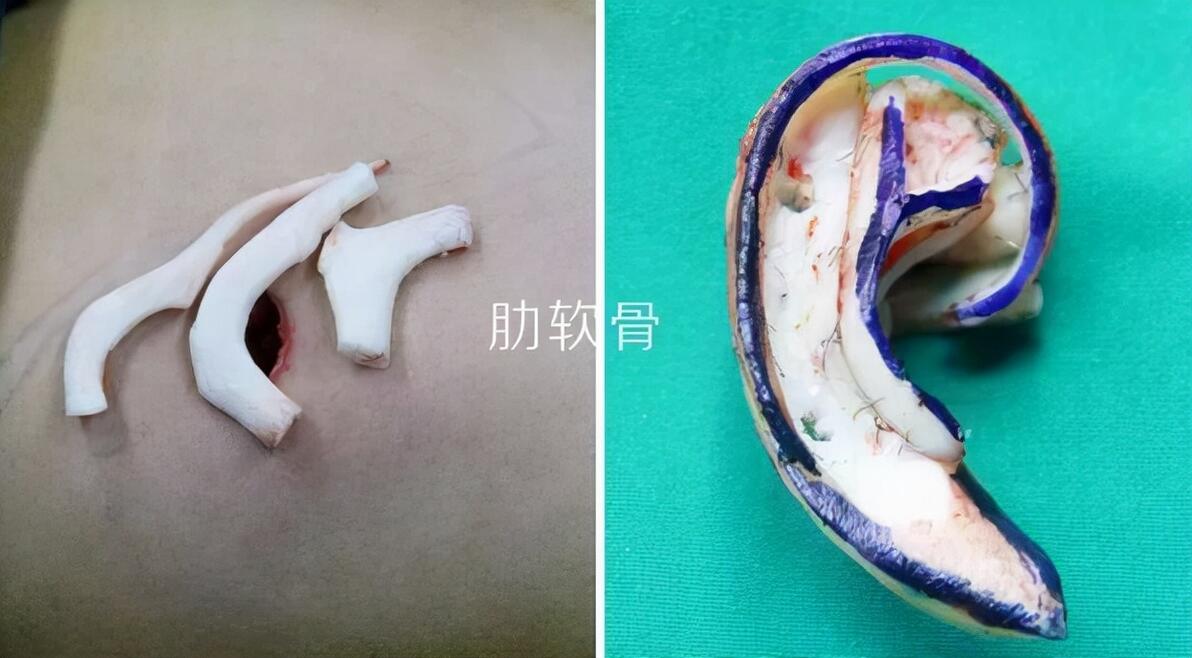 耳再造全包和半包区别,耳再造有几种方法? - 哔哩哔哩