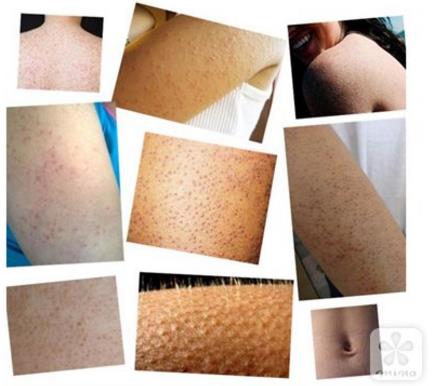 为什么皮肤会变鸡皮(皮肤为什么慢慢变成鸡皮了) 为什么皮肤会变鸡皮(皮肤为什么慢慢变成鸡皮了)