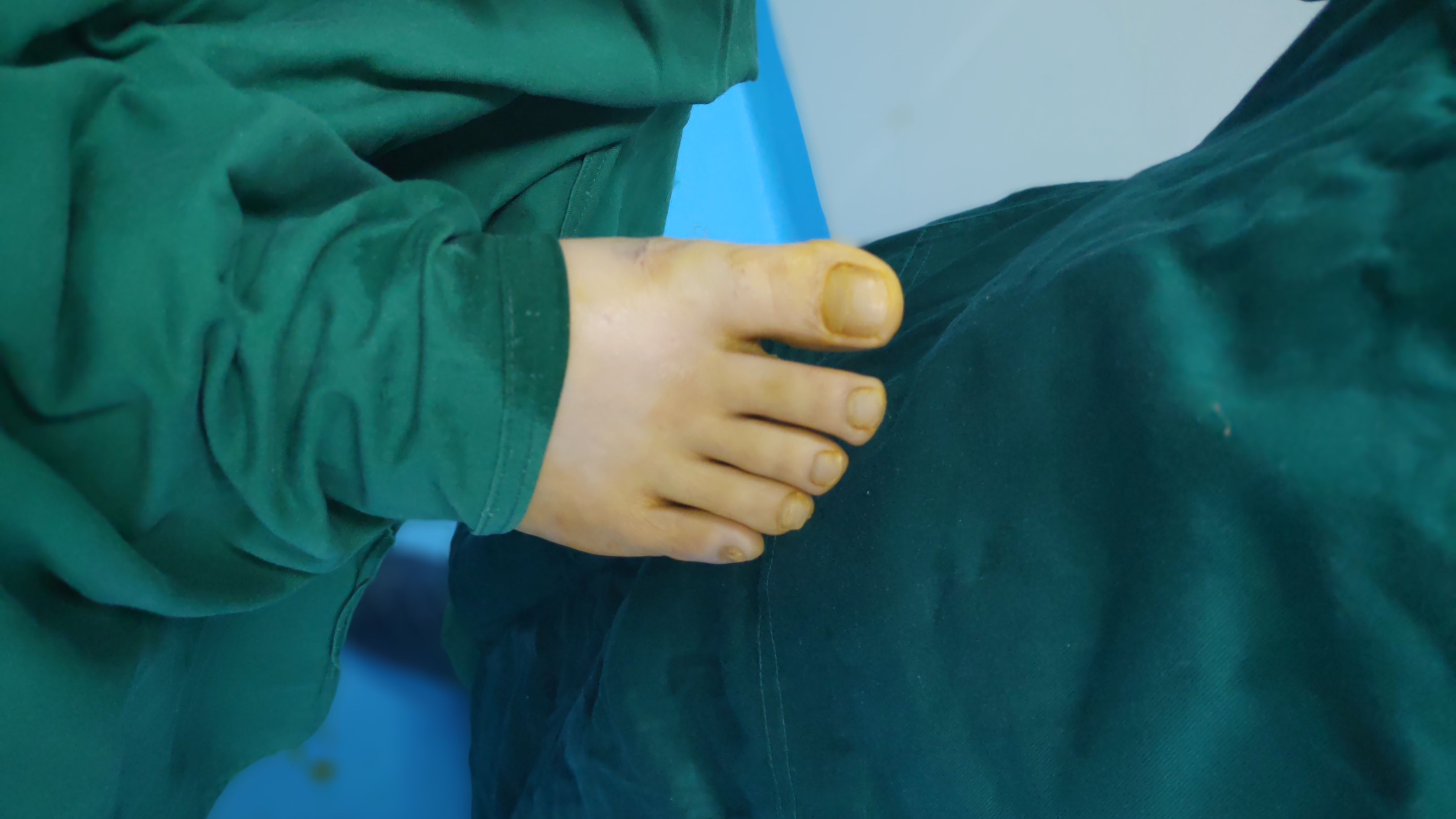 看看做大脚骨手术的流程，从消毒铺巾到做好 - 哔哩哔哩