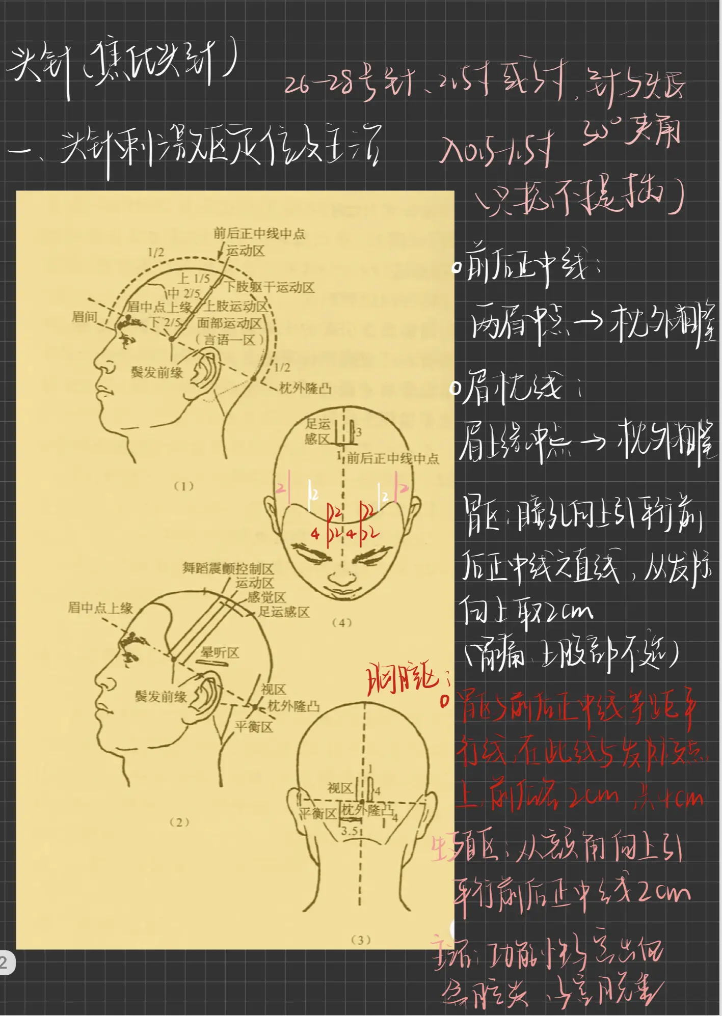 针灸之头针治疗偏瘫(焦氏头针➕蓝田头针)