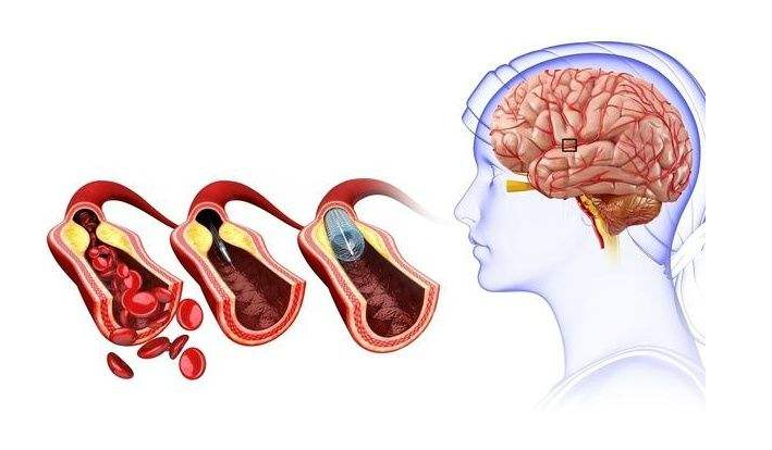 腦鳴是一種什麼樣的現象?和耳鳴一樣嗎?