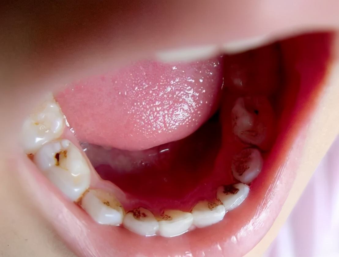 儿童蛀牙早期图片