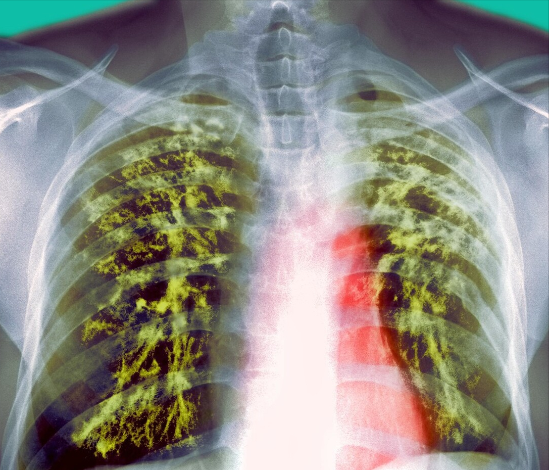 病例119 原发型肺结核(一)-X线读片-医学