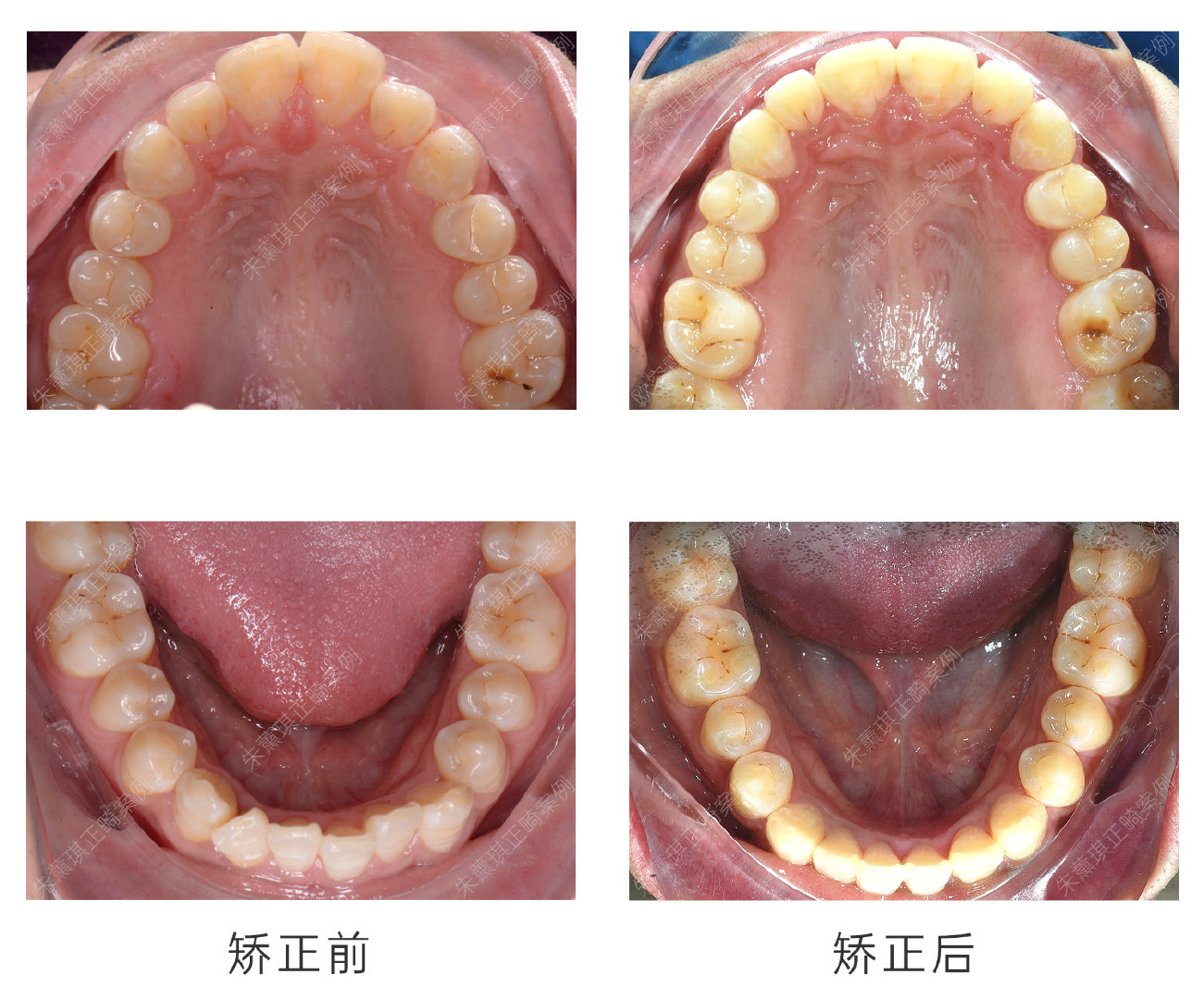 嘴突龅牙+下巴后缩+深覆合+开唇露齿矫正案例