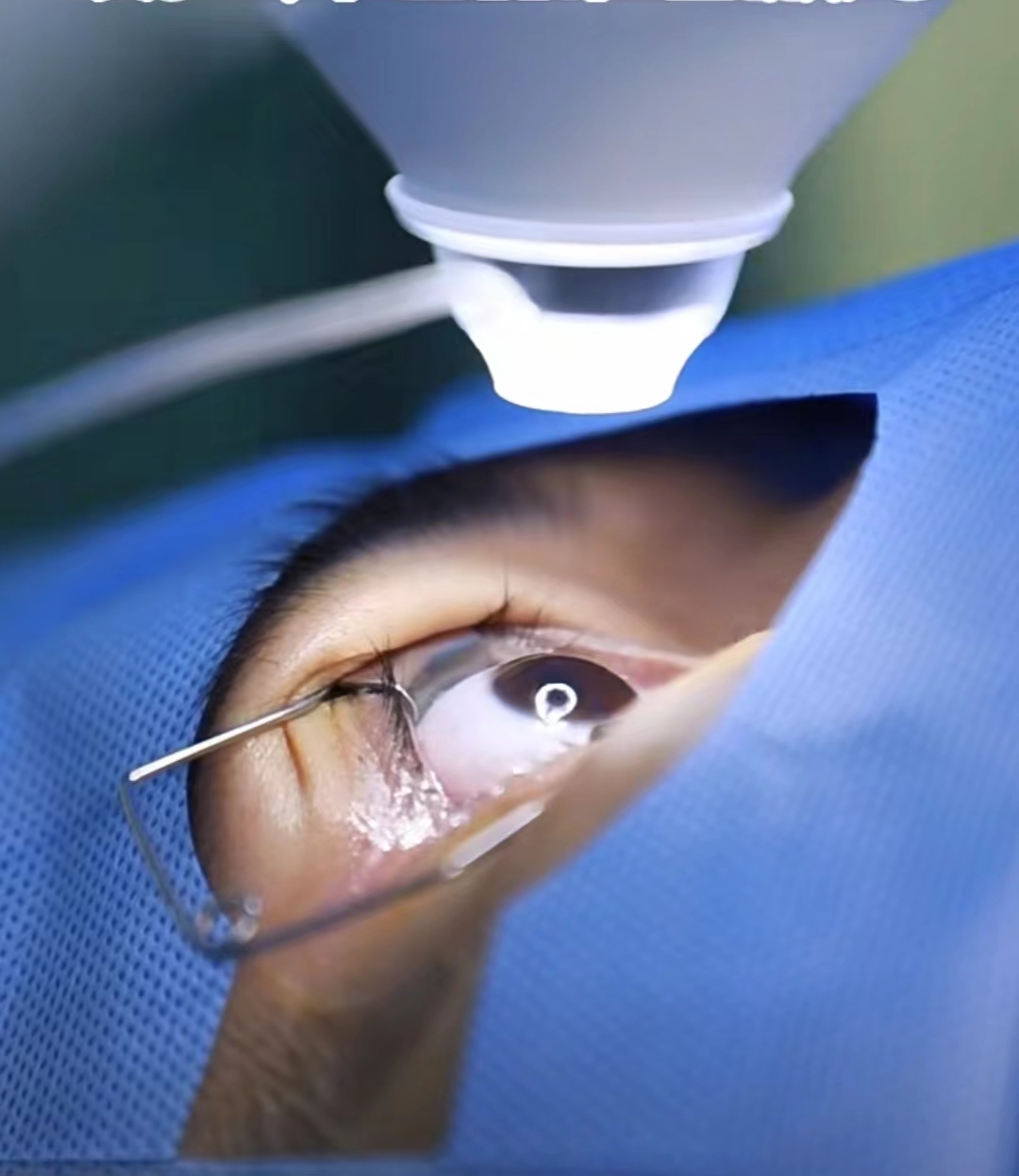 天津市眼科医院--什么是全飞秒激光角膜屈光手术？