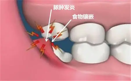 深圳拔智齿 智齿肿痛可以立马拔除吗 哔哩哔哩