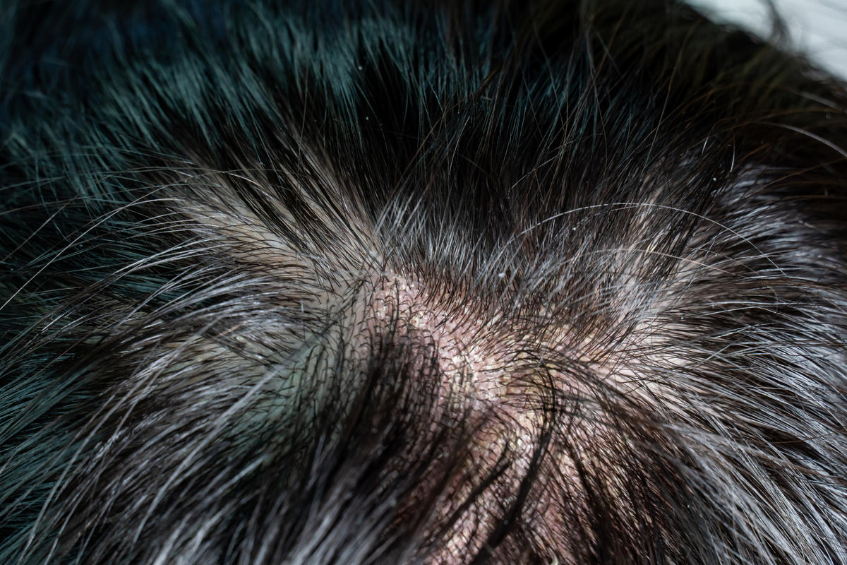 详解拉头发的危害铭记这几点尤为重要 - 早旭经验网