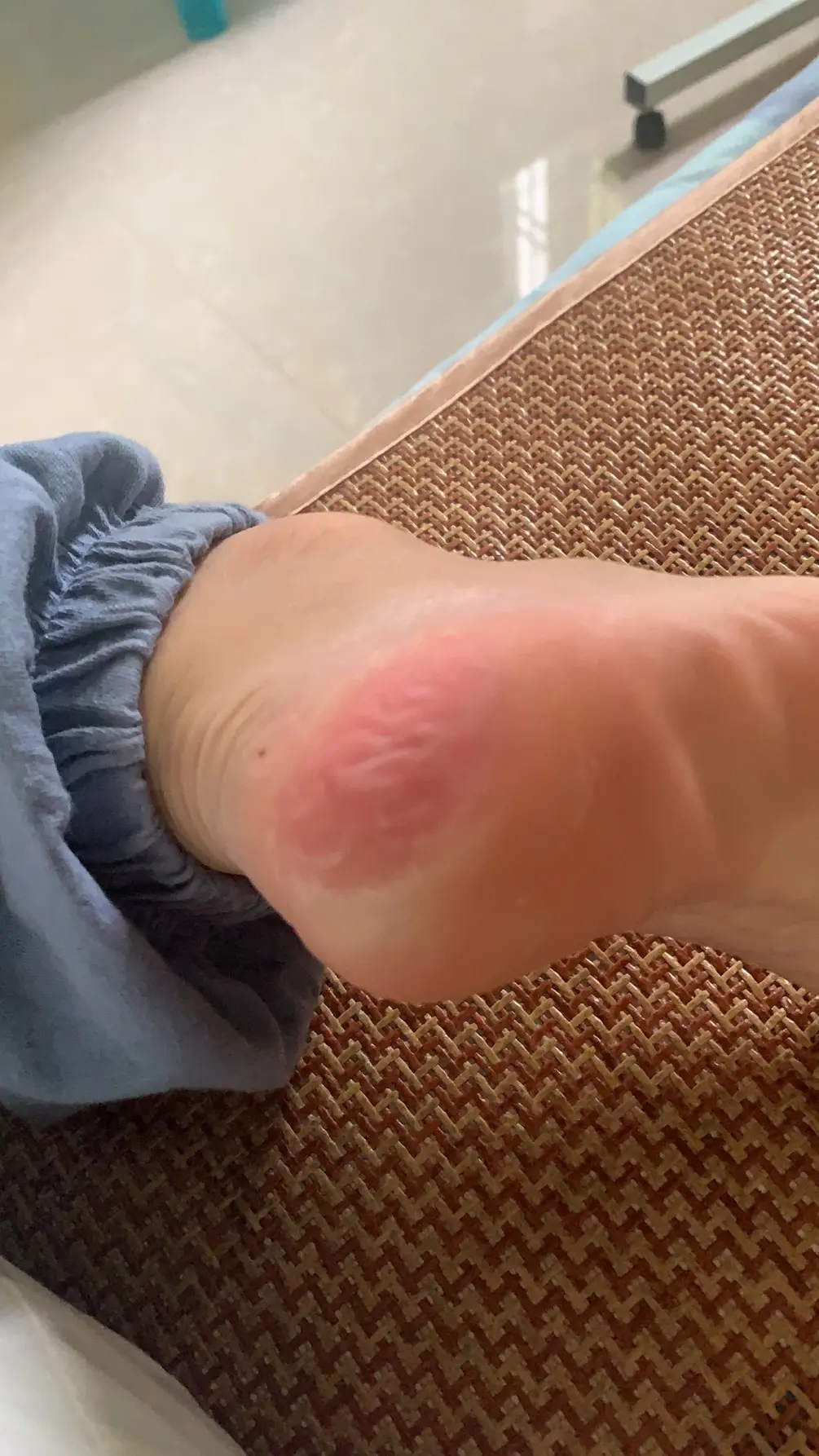 我后脚跟角化型足癣是怎么快速治好的 - 哔哩哔哩