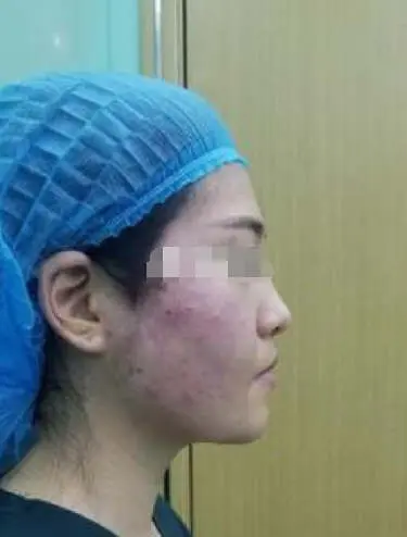埋线提升面部要几根线，线雕面部提升多久做一次
