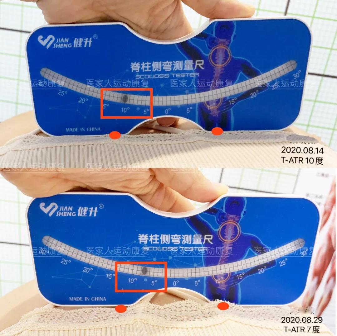 【脊柱侧弯康复】成人脊柱侧弯矫正治疗不到一个月剃刀背减少3度!疼痛消失! - 哔哩哔哩