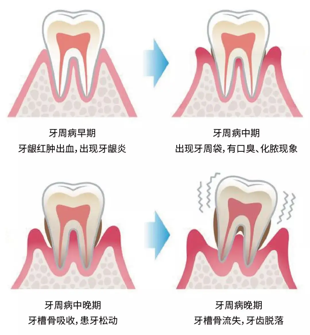 1最近左边牙齿牙龈（大概牙齿根部)有小白色突起，按压酸痛。2口腔溃疡4个。鼻塞头痛。_百度知道