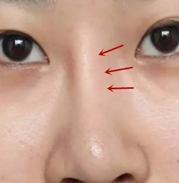 黄海滨:为什么有些人隆鼻后鼻子是歪的?