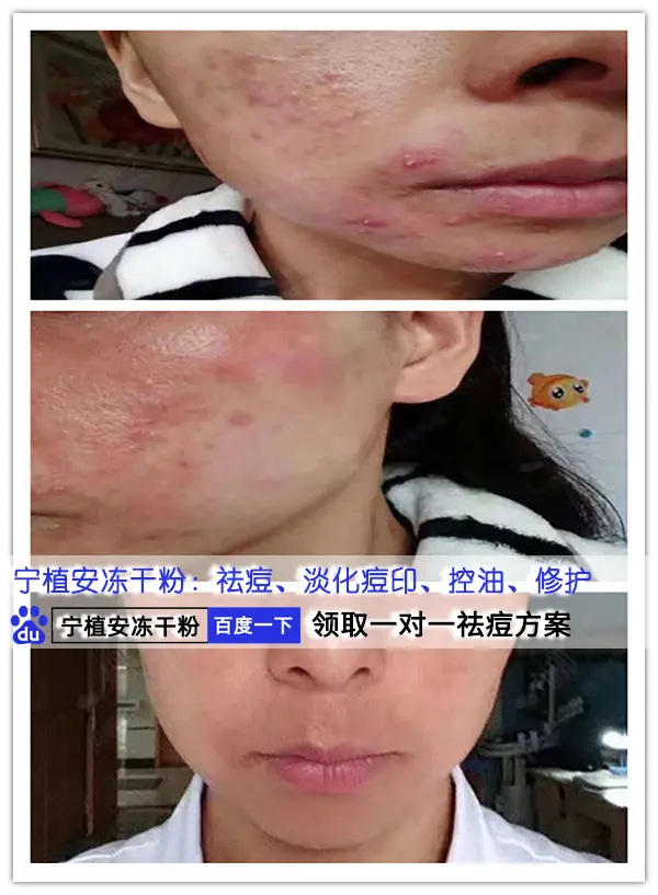 青春痘怎么消 中学生满脸长痘痘怎么治疗 哔哩哔哩