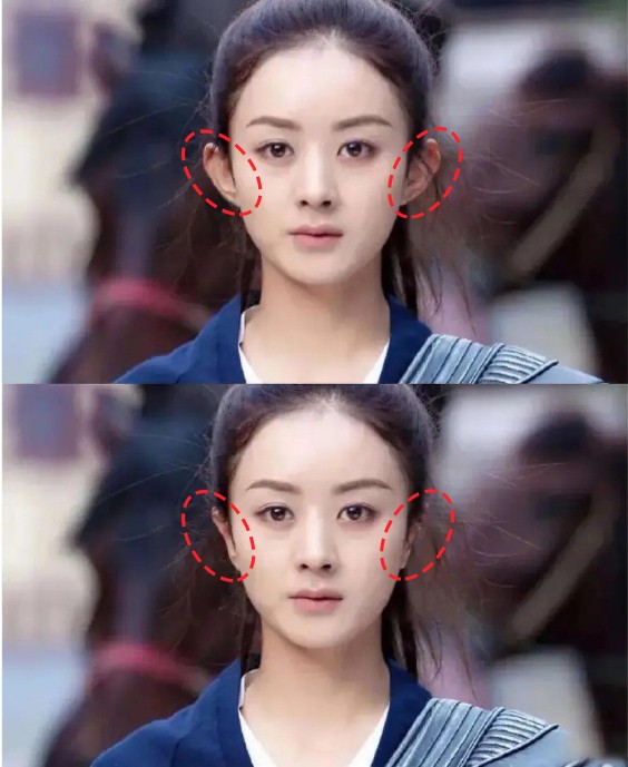 不打针不动骨就能小脸贴发耳矫正术效果竟这么好不妨看看实例