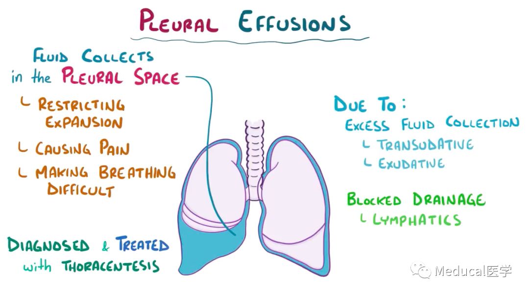 collects in the pleural space around the lungs,  restricting